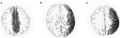 Clinical and Radiological Features of Adult Onset Bilateral Medial Frontal Cerebral Cortical Encephalitis With Anti-myelin Oligodendrocyte Glycoprotein Antibody